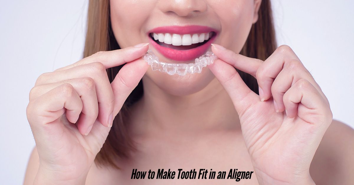 How-to-Make-Tooth-Fit-in-an-Aligner